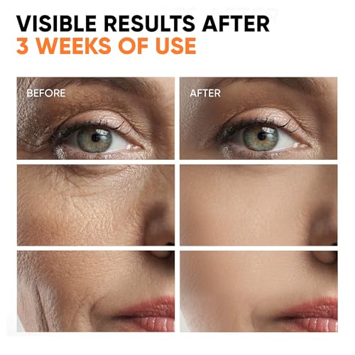 Vitamin C Serum for Face (1 Fl Oz (Pack of 1))