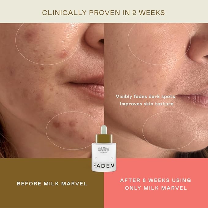 EADEM Milk Marvel Dark Spot Serum, Vitamin C Face Serum Infused with Niacinamide, Dark Spot Remover for Face and Body, Natural Dark Spot Corrector for Skin Care, 1 oz