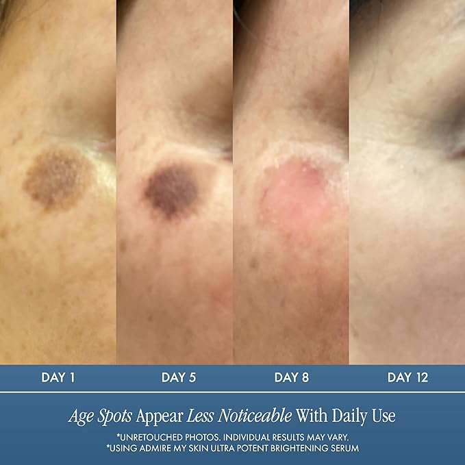 Admire My Skin Dark Spot Corrector Remover for Face - Brightening Discoloration Correcting Serum - Kojic Acid + Azelaic Acid Serum for Melasma and Sun Spots 1oz