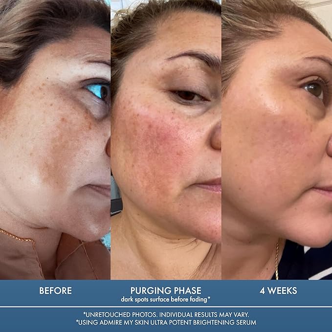 Admire My Skin Dark Spot Corrector Remover for Face - Brightening Discoloration Correcting Serum - Kojic Acid + Azelaic Acid Serum for Melasma and Sun Spots 1oz