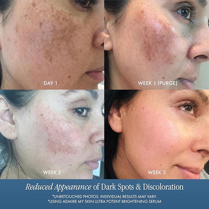 Admire My Skin Dark Spot Corrector Remover for Face - Brightening Discoloration Correcting Serum - Kojic Acid + Azelaic Acid Serum for Melasma and Sun Spots 1oz